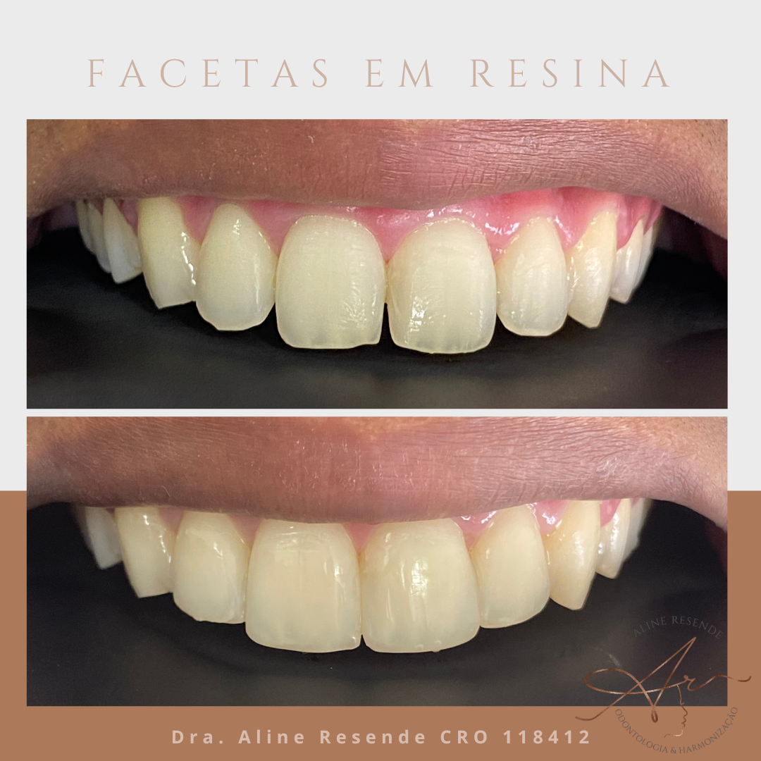 Como Conquistar um Sorriso Perfeito. Um sorriso bonito não só melhora a estética, mas também pode aumentar a confiança e a qualidade de vida.