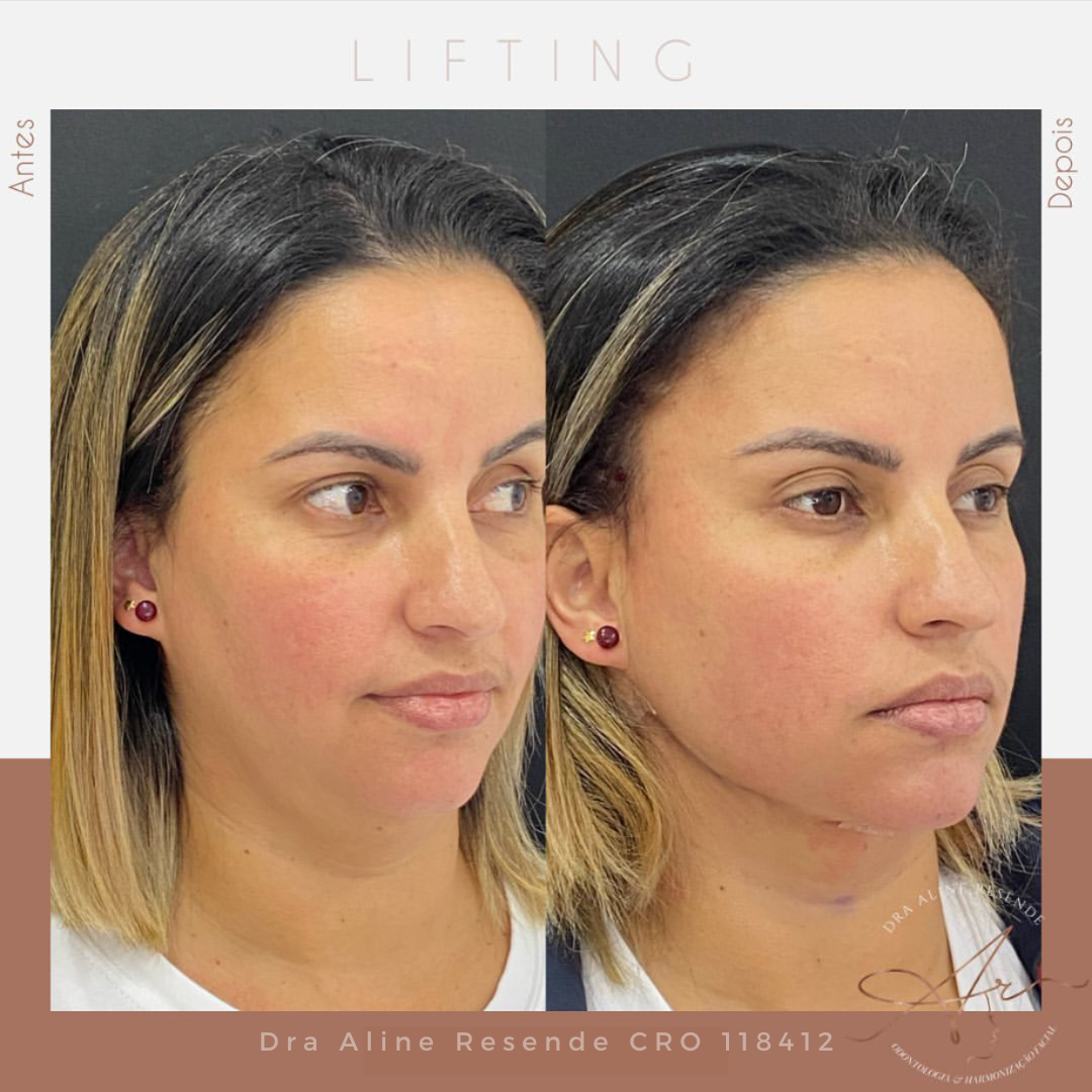 O lifting facial é um procedimento estético que tem como objetivo diminuir as rugas do rosto e pescoço, além de reduzir a flacidez da pele.