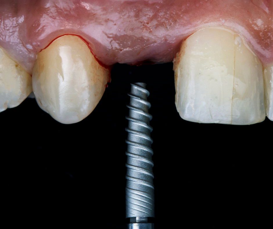 Quanto Custa um Implante Dentário? Saiba os Fatores que Influenciam o Valor