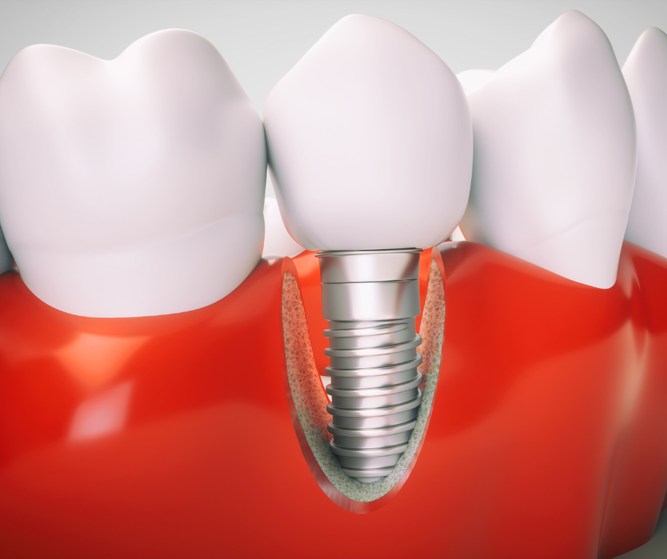 Implante dentário de carga imediata Clínica A R