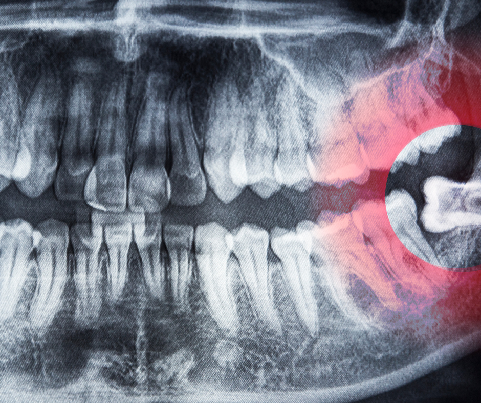 Neste artigo, exploraremos os sinais de que chegou a hora de remover os dentes do siso e como funciona o procedimento.